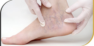 Sclerotherapy Treatment Specialist Near Me in Beverly Hills and Hollywood, CA